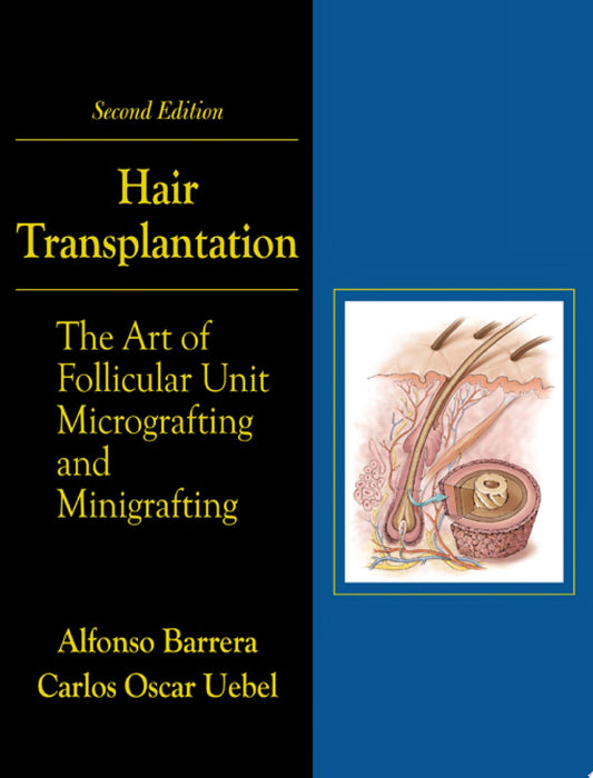 Hair Transplantation: The Art of Micrografting and Minigrafting, Second Edition