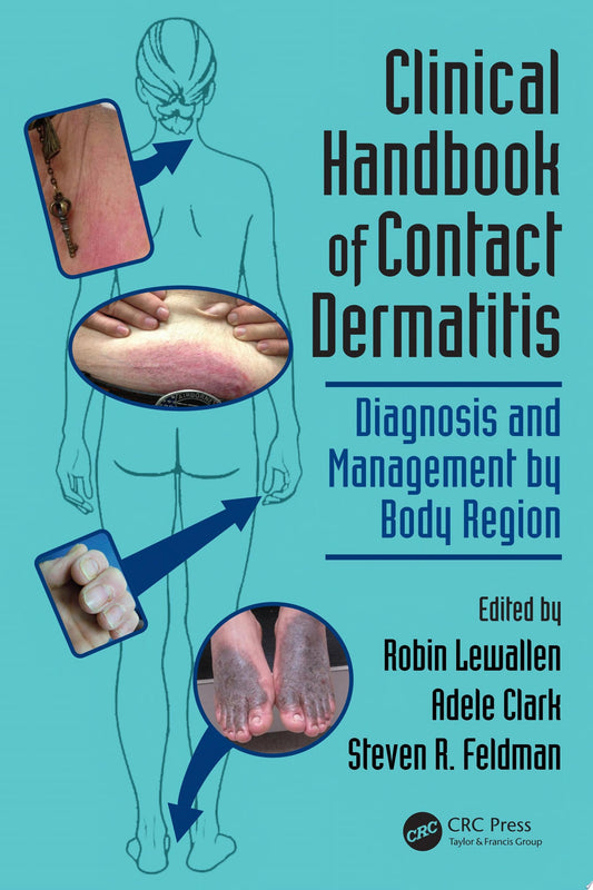 Clinical Handbook of Contact Dermatitis: Diagnosis and Management by Body Region 1st Edition